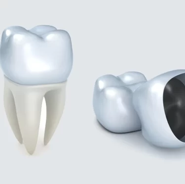 Signs-You-May-Need-a-Dental-Crown
